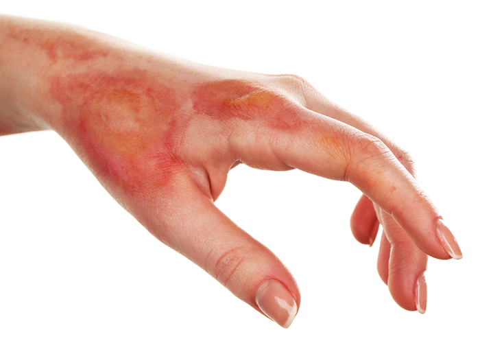 The Best Home Remedies For Burns