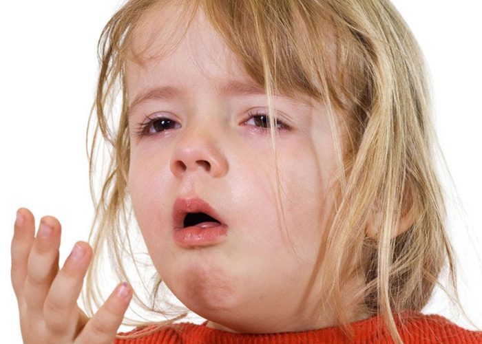 Croup: Causes,Symptoms,Types,Treatment