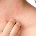 What Is Eczema? and Types of Eczema