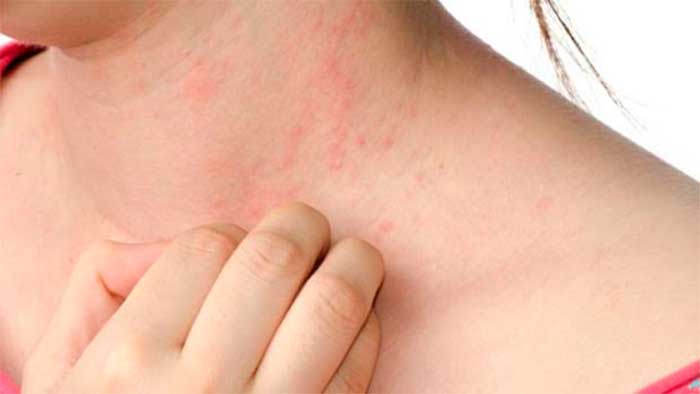 What Is Eczema? and Types of Eczema