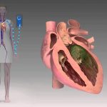 Endocarditis