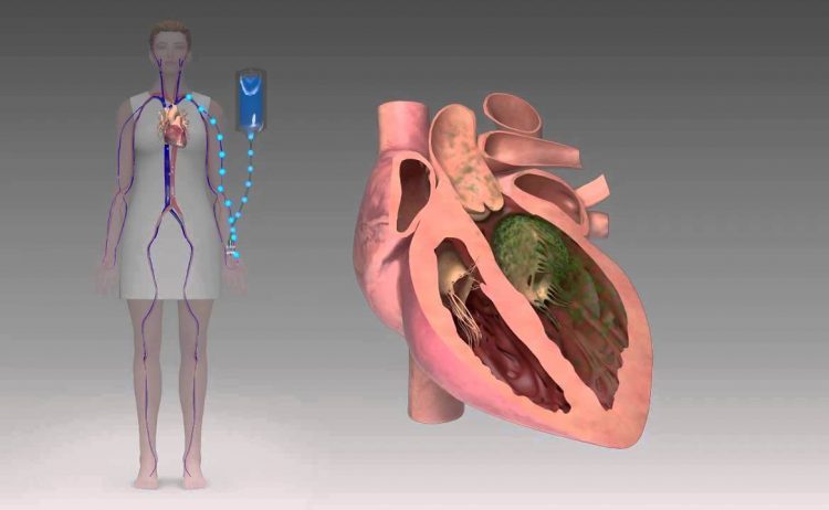 What Is Endocarditis And Infective Endocarditis? Endocarditis